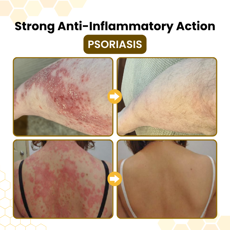Zyrelise® PsoriaSoothe Bee Venom Skin-Restoration Cream