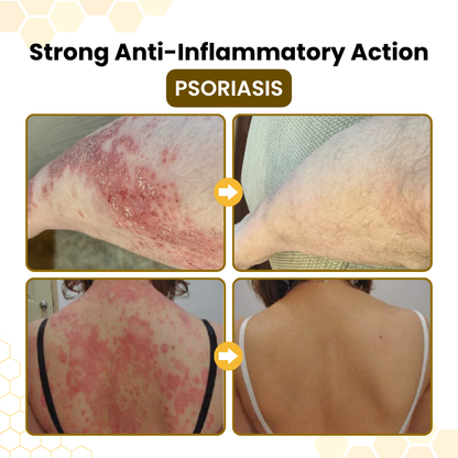 Zyrelise® PsoriaSoothe Bee Venom Skin-Restoration Cream