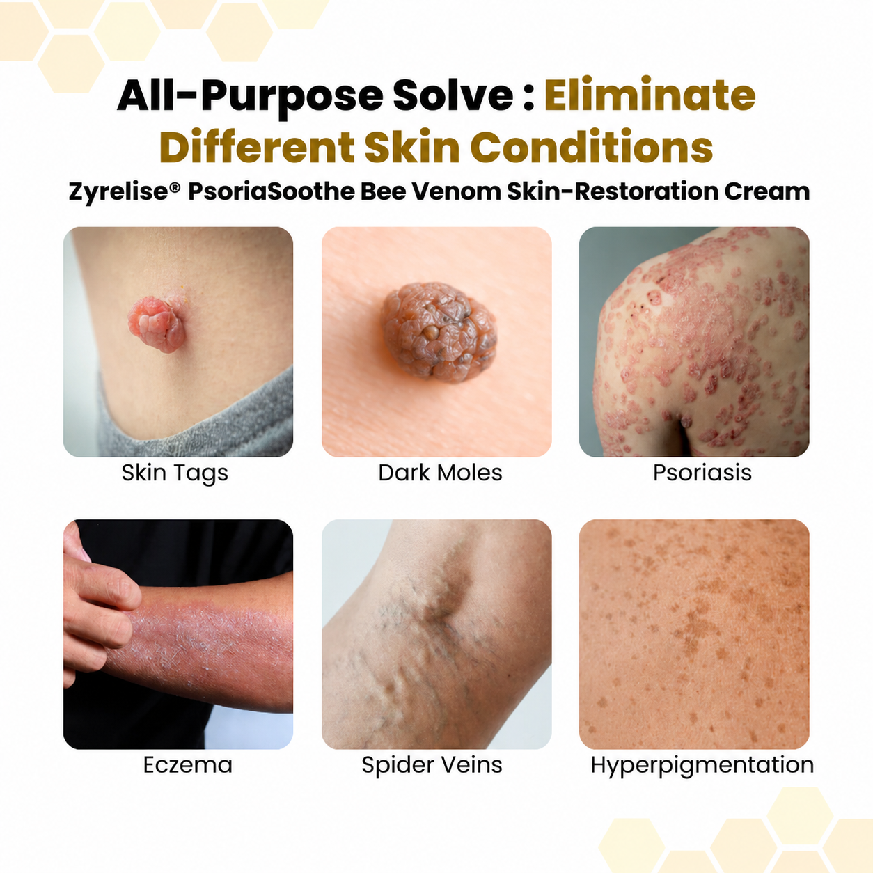 Zyrelise® PsoriaSoothe Bee Venom Skin-Restoration Cream
