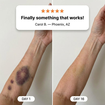 💥100K+ SOLD💕- Zyrelise™ Bruise Repair & Skin-Strengthening Cream
